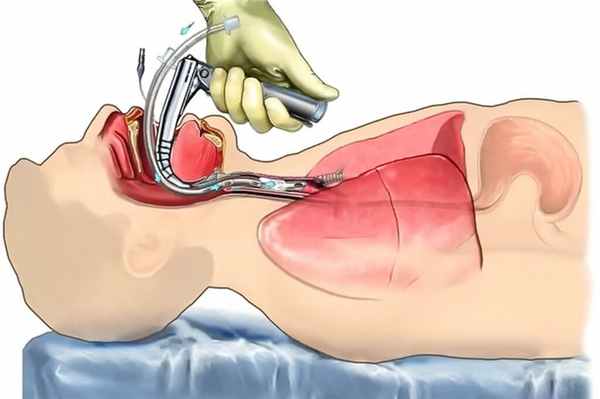 Вентиляция легких при торакоскопии