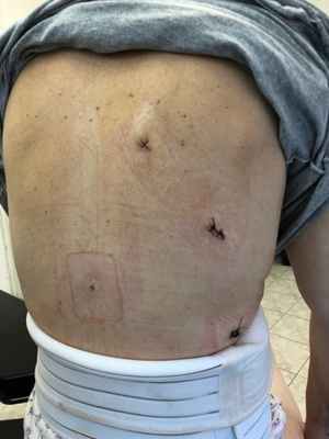 Вид послеоперационных ран после торакоскопии