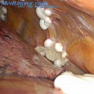 торакоскопия при сколиозе