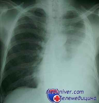 торакоскопия при травме груди