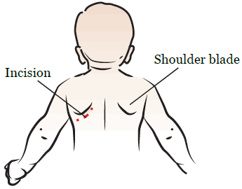 Рисунок 2. Торакотомический разрез
