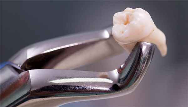 Удаление ретинированного зуба мудрости