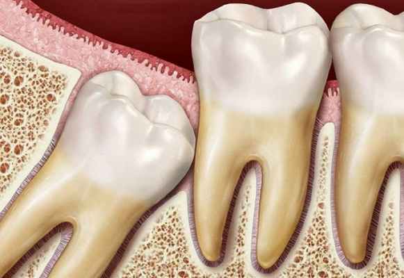 Ретенция зуба