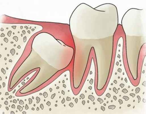 Ретинированный зуб