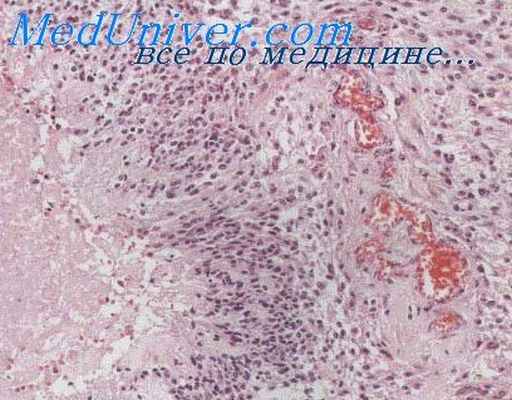 криптококкоз