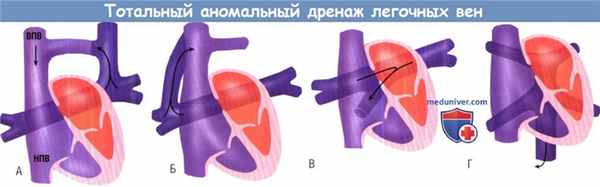 Тотальный аномальный дренаж легочных вен