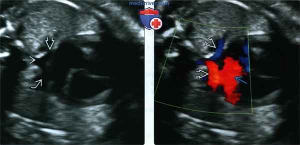 УЗИ, ЭхоКГ при тотальном аномальном дренаже легочных вен у плода