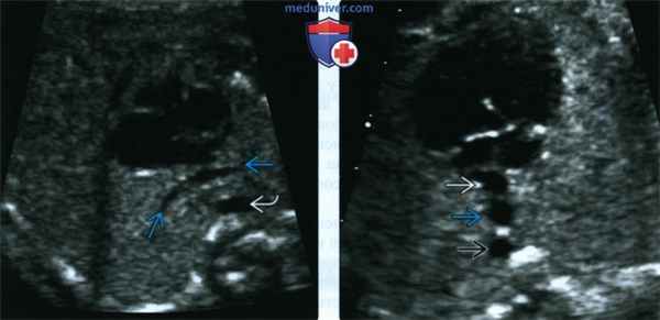 УЗИ, ЭхоКГ при тотальном аномальном дренаже легочных вен у плода