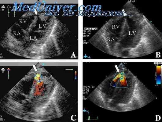 эхокардиография