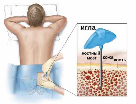 пересдка костного мозга