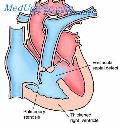 гипоплазия легочной артерии