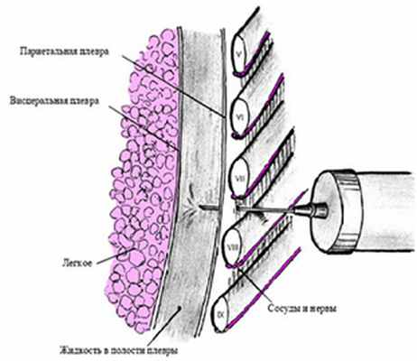 Торакоцентез