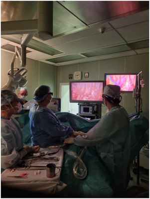 Видеоторакоскопическая плеврэктомия по поводу карциноматозного плеврита