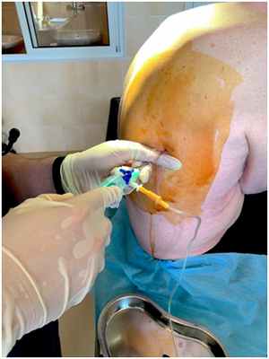 Выполнение лечебно-диагностического торакоцентеза справа