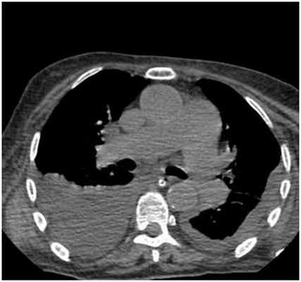 Двусторонний гидроторакс