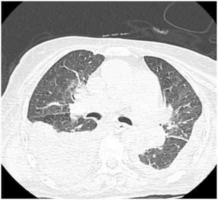 Двусторонний гидроторакс