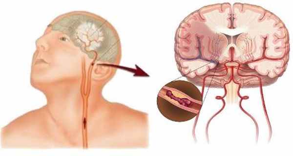 Транзиторная ишемическая атака