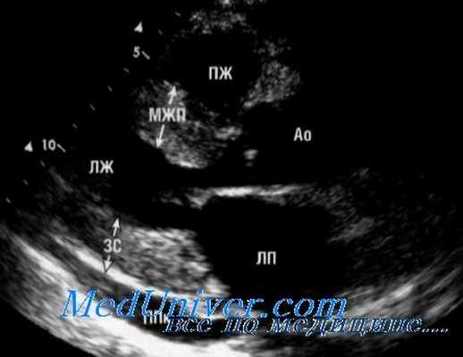 амилоидоз сердца