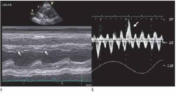 Хронический констриктивный перикардит. А - М-режим ЭхоКГ из парастернальной позиции. Представлены типичные особенности констриктивного перикардита, инцизура МЖП (показана стрелкой), и выравнивание задней стенки ЛЖ. Б - запись пульсовой допплерографии печеночной вены. Диастолический поток увеличивается на выдохе (показано стрелкой).