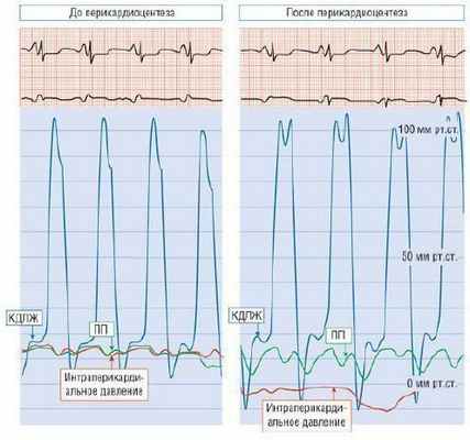 Экссудативно-констриктивный перикардит. До перикардиоцентеза интраперикардиальное давление, давление в ПП и КДД в ЛЖ повышены (14 мм рт.ст.). После перикардиоцентеза петля внутриперикардиального давления ниже нуля, тогда как давление в ПП и ЛЖ остается почти неизменным и появляется признак падение-плато при записи давления в ЛЖ.