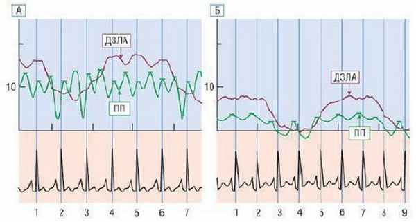 Транзиторная констрикция перикарда. А - давление заклинивания в ЛА и давление в ПП одинаково повышены (10 мм рт.ст.), и запись давления имеет