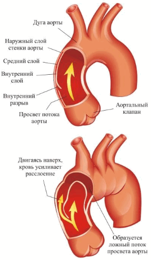 Расслоение грудной аорты