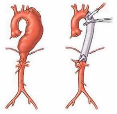 Установка транспланта
