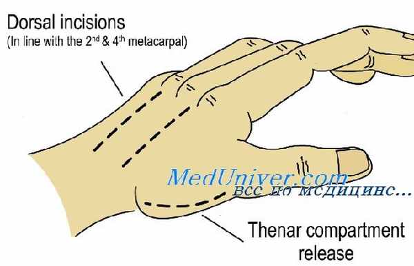 компартмент синдром