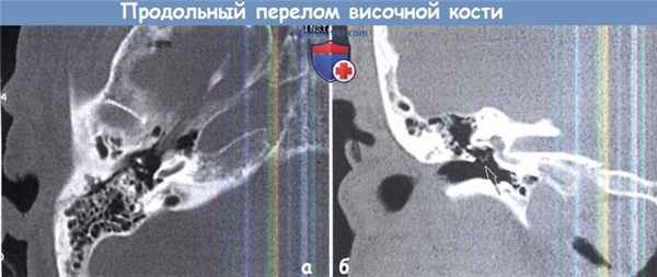 Продольный перелом височной кости