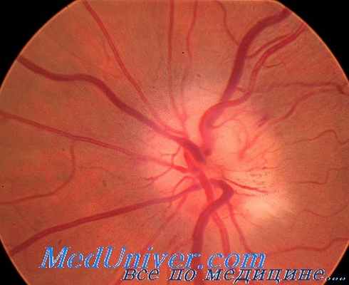 травматическая невропатия зрительного нерва