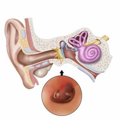 Перфорация барабанной перепонки