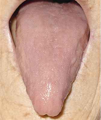 Рис. 3. «Лакированный» язык у больной В12-дефицитной анемией.