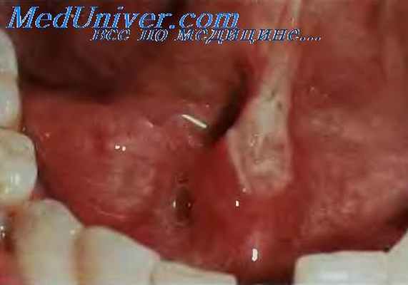 травматическая язва уздечки