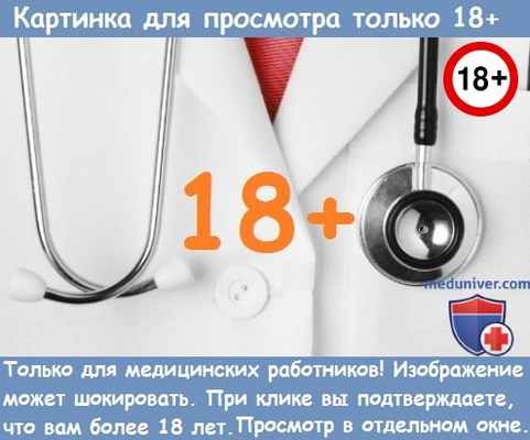 Тантум® Прополис