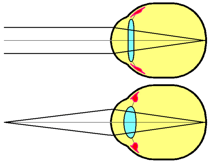 Аккомодация глаза: виды, причины и варианты лечения1