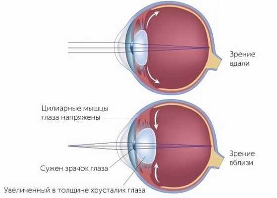Спазм аккомодации