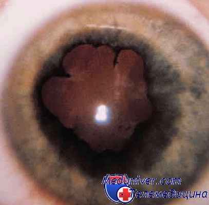 мидриаз и спазм аккомодации