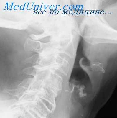 травма щитовидного хряща