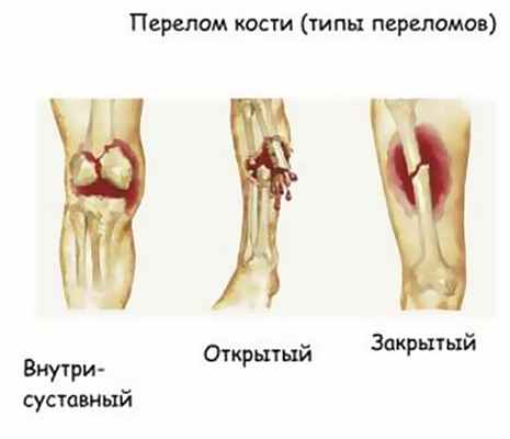 Типы переломов