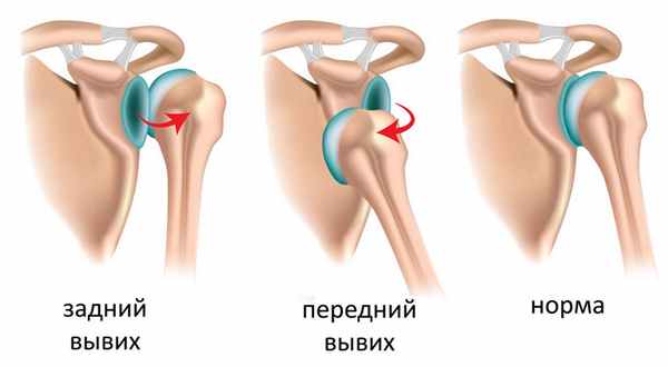 Виды вывихов