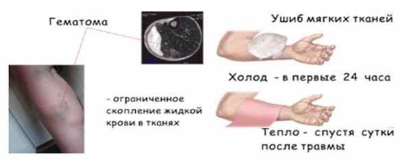 Ушиб мягких тканей