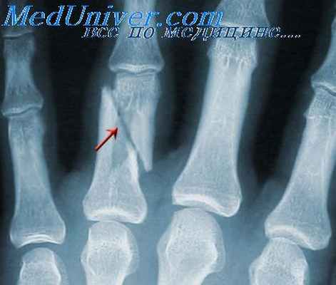 травмы скелета