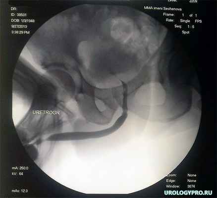 razryv-uretry6