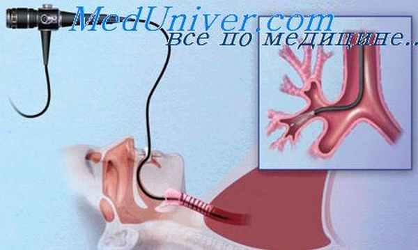 трахеобронхоскопия