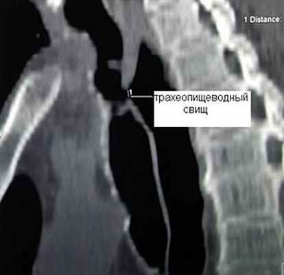 Компьютерная томограмма больного с трахеопищеводным свищом