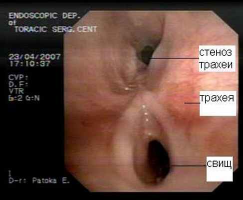 Трахеоскопия больного с трахеопищеводным свищом
