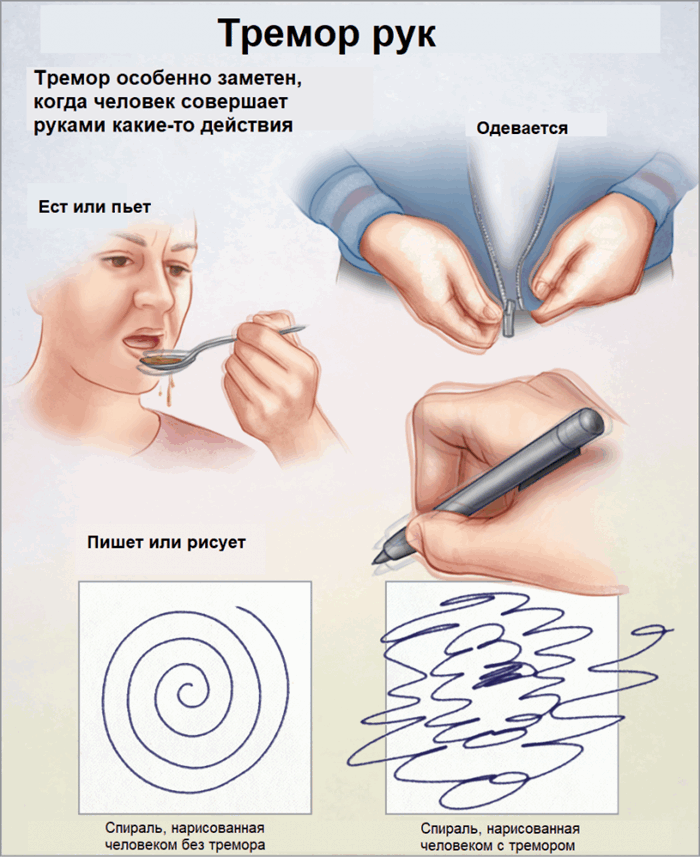 Эссенциальный тремор.png