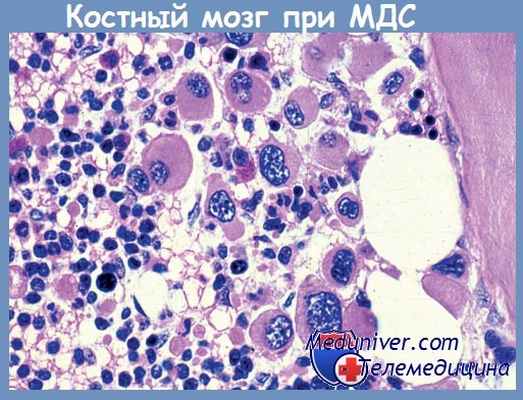 костный мозг при миелодиспластическом синдроме (МДС)