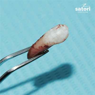 травма зуба, выбитые зубы