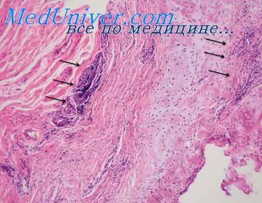 дифференциация сифилиса